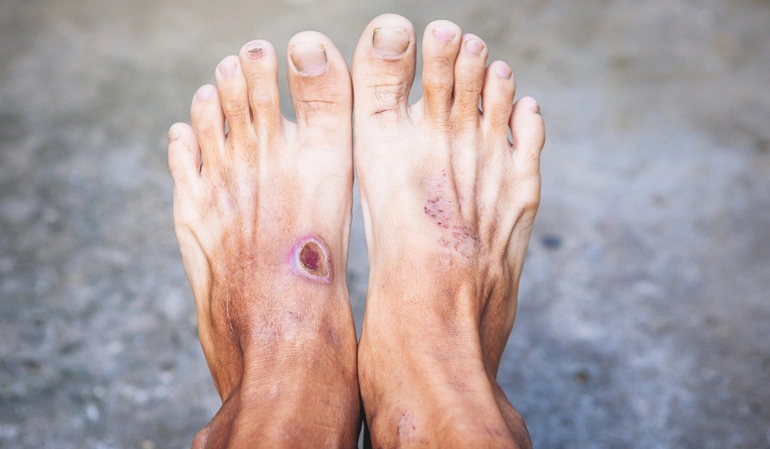 Content image Diabetic foot